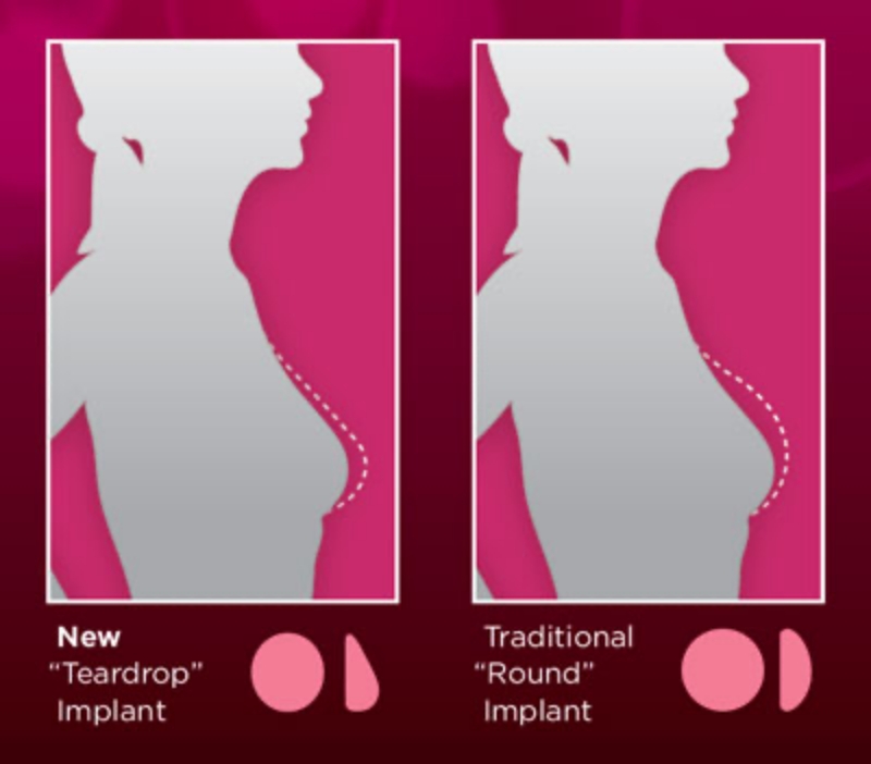 3 Benefits of Tear Drop Breast Implants - Dr. York Yates Plastic