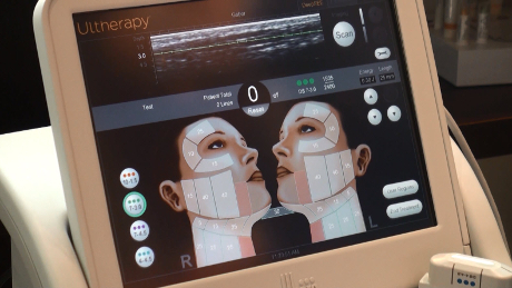 ultherapy ultrasound image