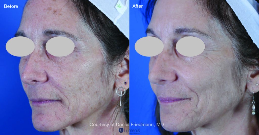 Photofacial Before and After Photos | Utah Cosmetic Surgery